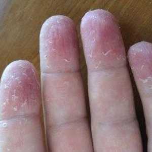 Zakaj kožo na prste
