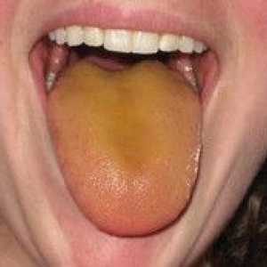 Pri katerih boleznih je rumenkasto zeleni premaz na jeziku