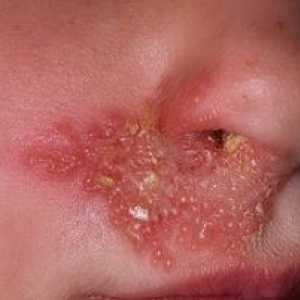 Vzroki in zdravljenje herpesa na obrazu