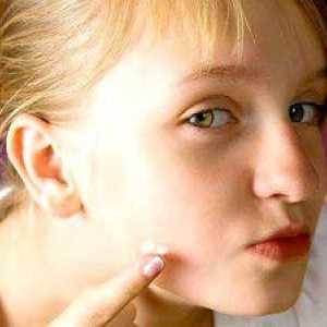 Vzroki in zdravljenje aken na obrazih žensk