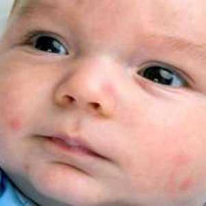 Vzroki za pojav rdečih pik na obrazu otroka