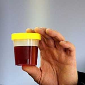 Vzroki temnega urin pri moških