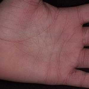 Vzroki za srbenje dlani - zakaj so moje roke srbeče?