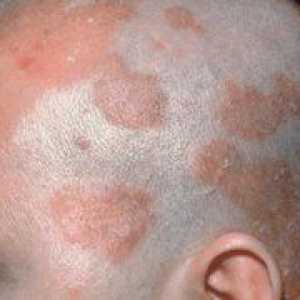 Seborrheski dermatitis lasišča: zdravljenje in fotografije
