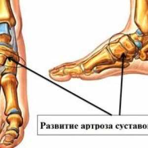 Simptomi noge artroze in sklepov na nogi s fotografijami