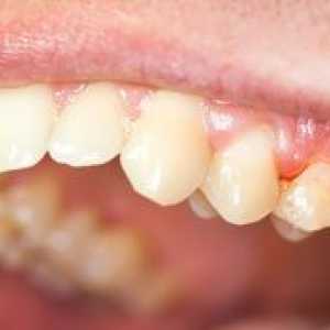 Simptomi in zdravljenje kroničnega periodontitisa