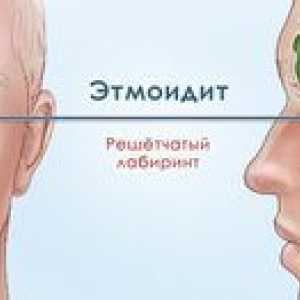 Simptomi in zdravljenje etmoiditisa in antrata
