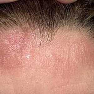 Simptomi in zdravljenje seborejskega dermatitisa lasišča