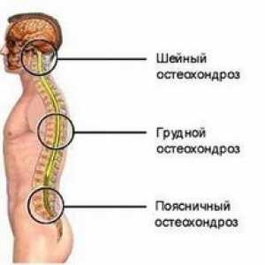 Simptomi osteohondroze vratne in prsne hrbtenice