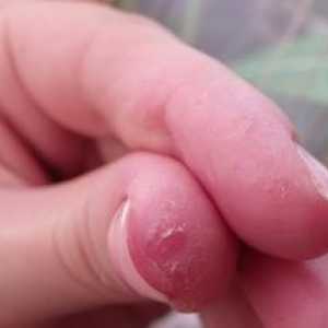 Koža je olupljena na prstih: zakaj se to zgodi