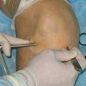 Obnova po operaciji artroskopije kolenskega sklepa: pregledi