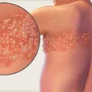 Seznanitev z herpes zoster: simptomi in zdravljenje