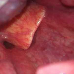 Abscess epiglottis v otroški fotografiji