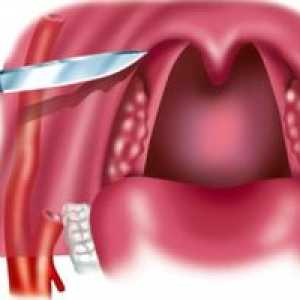 Abcess v grlu - kaj je to, vrste, simptomi in zdravljenje