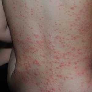 Alergijski izpuščaj, ki je na telesu otroka: fotografije in opombe