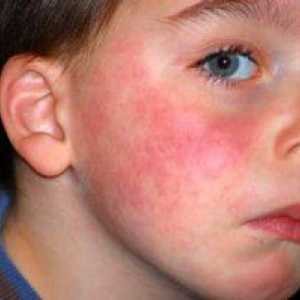 Alergija na mleko pri otroku, simptomi in razvoj