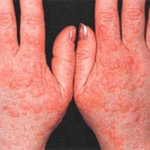 Alergije na rokah in prstih s fotografijo