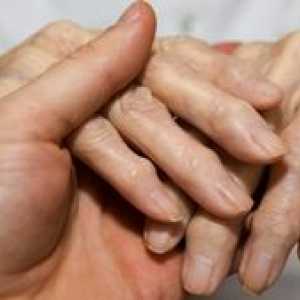 Artritis prstov: simptomi bolezni in potrebno zdravljenje