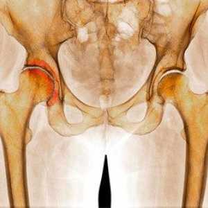 Osteoartritis kolka 1 in 2 stopinje: metode zdravljenja