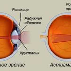 Astigmatizem očesa: kaj je to, fotografija, zdravljenje pri odraslih