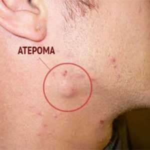 Atheroma: vzroki, simptomi in zapleti