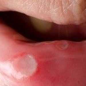 Bela obloga na ustnicah: vzroki, simptomi, zdravljenje