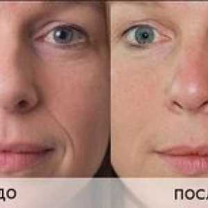Neinjektivna biorevitalizacija obraza s hialuronsko kislino