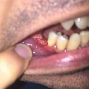 Poškodovane dlesni po ekstrakciji zob, kaj storiti