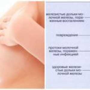 Prsni koš med dojenjem: vzroki, simptomi in zdravljenje