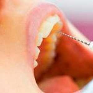Ali je bolno odstraniti živec iz zoba?