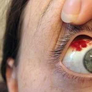 Kaj storiti, če je krvavitev oči: simptomi in zdravljenje