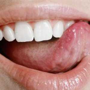 Kaj so bolečine v ustih?