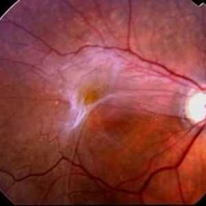 Kaj je epiretinalna fibroza oči?