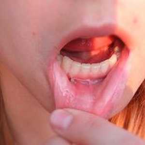 Kakšna je zadrževalna cista spodnje ustnice?