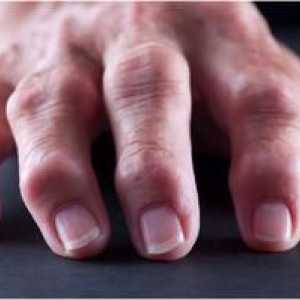 Kaj je revmatoidni artritis?