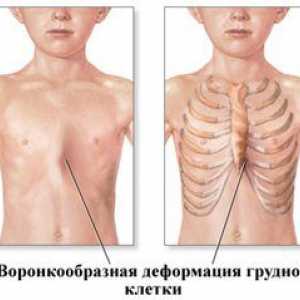 Deformacija prsnega koša pri otroku