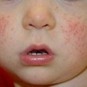 Dermatitis pri otroku: glavni vzroki, metode zdravljenja in fotografije