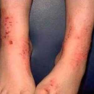 Otroški dermatitis na stopalih: fotografije, vrste in načini zdravljenja