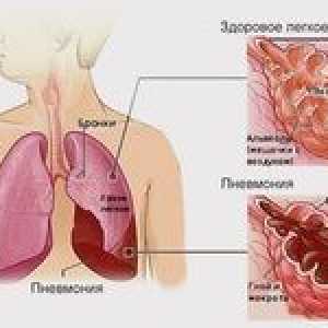 Dvostranska pljučnica: kako zdraviti pljučnico?