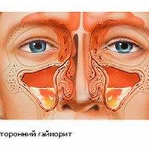 Dvostranski sinusitis pri otroku in odraslih