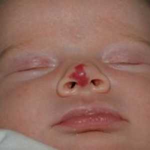 Hemangioma pri novorojenčku: fotografije in sorte