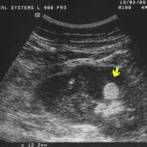 Hiperehoične oblike z ledvičnim ultrazvokom