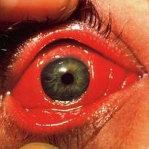 Mastno oko iz konjunktivitisa pri otroku in odraslih