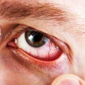 Diclofenak kapljice za oko: navodila za uporabo, cena