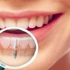 Vpliv zob: bistvo postopka za postavitev zobnega vsadka