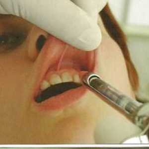 Infiltracijska anestezija v zobozdravstvu: značilnosti