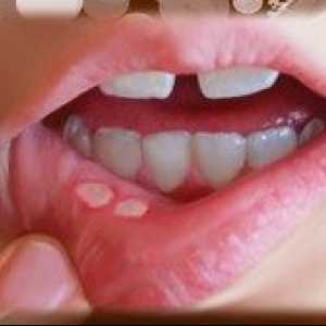 Rane v ustih in vzroki zdravljenja