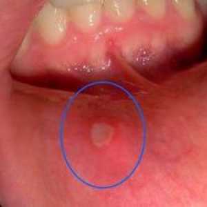 Bolezni v ustih: vzroki, simptomi, zdravljenje in preprečevanje