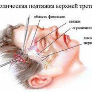 Endoskopski obrazni dvig: indikacije in kontraindikacije
