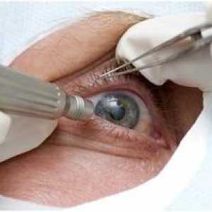 Kako zdraviti artefaktične oči in kaj je to